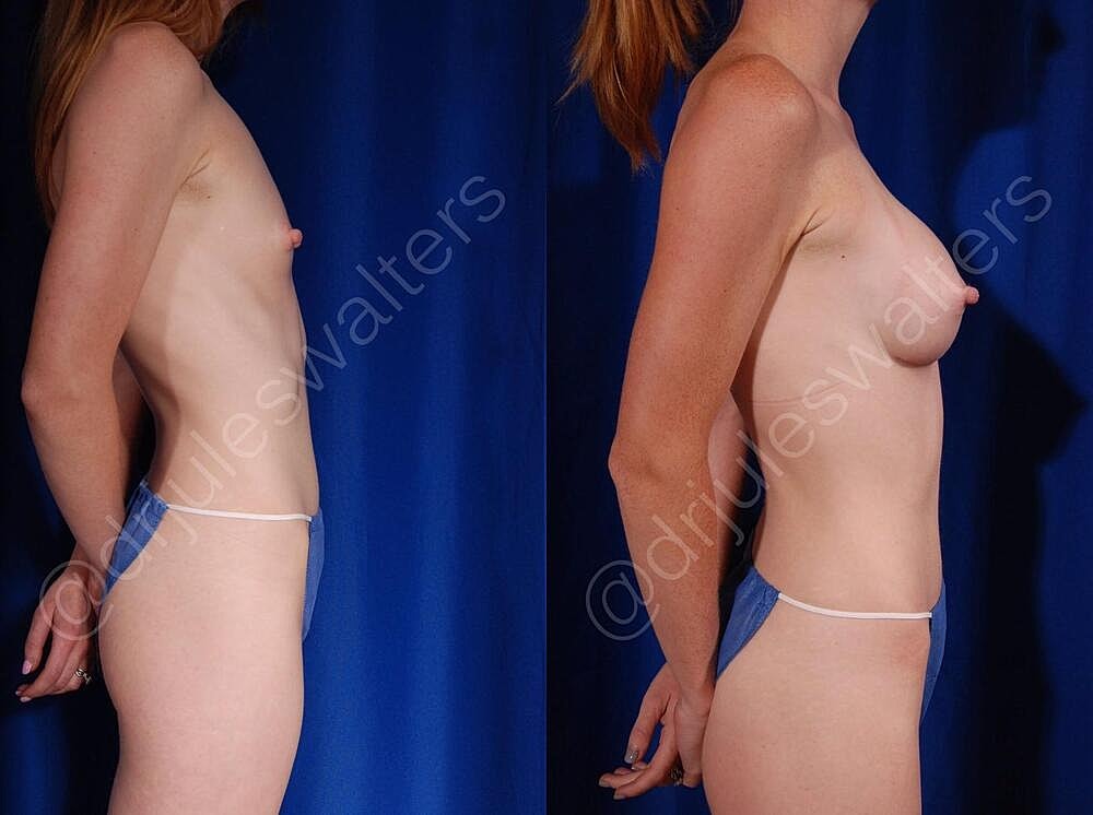 Breast Augmentation Before & After