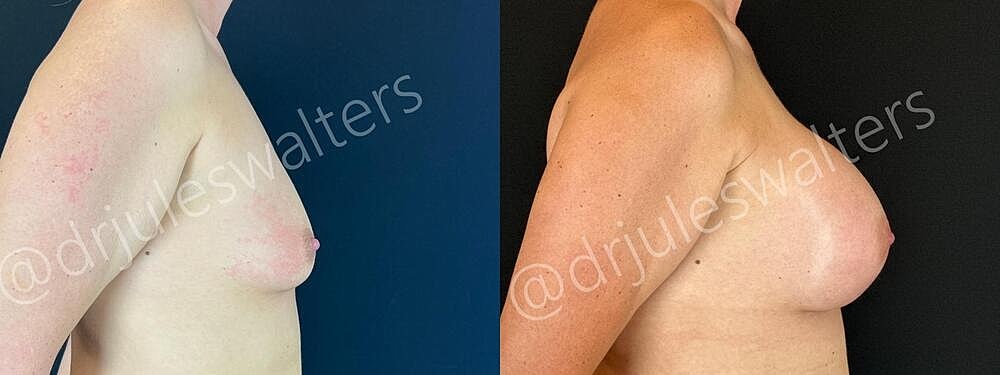 Breast Augmentation Before & After