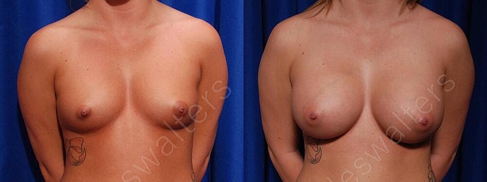 Breast Augmentation Before & After