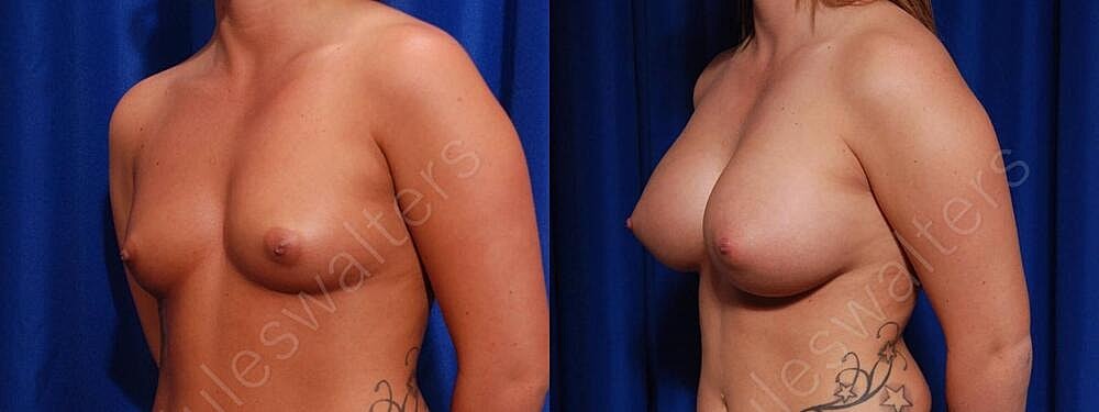 Breast Augmentation Before & After