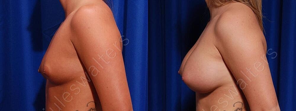 Breast Augmentation Before & After