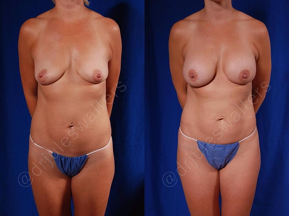 Breast Augmentation Before & After