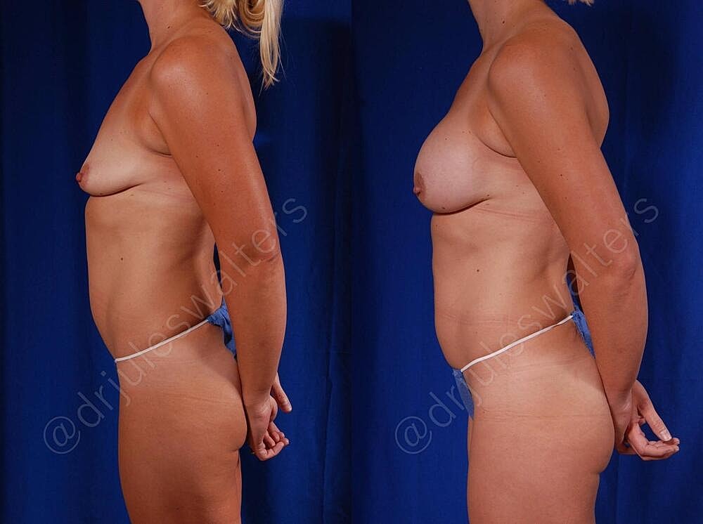 Breast Augmentation Before & After