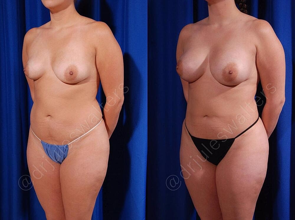 Breast Augmentation Before & After