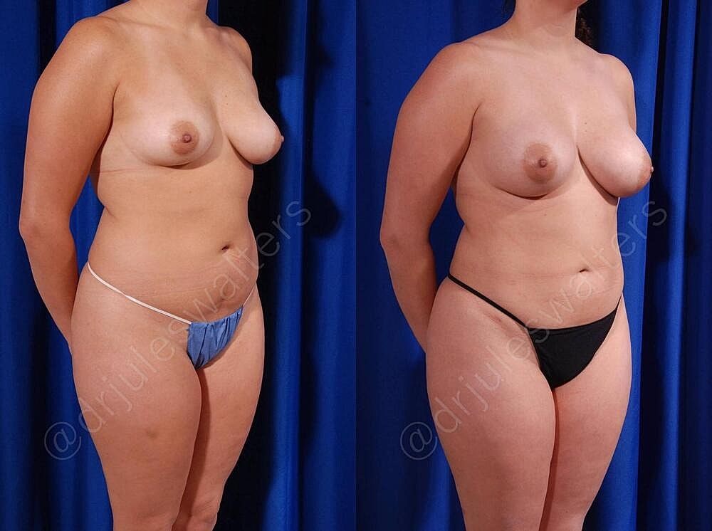 Breast Augmentation Before & After