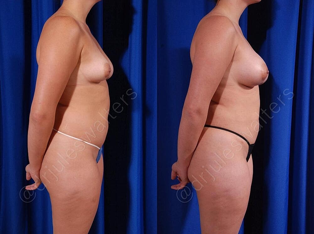 Breast Augmentation Before & After