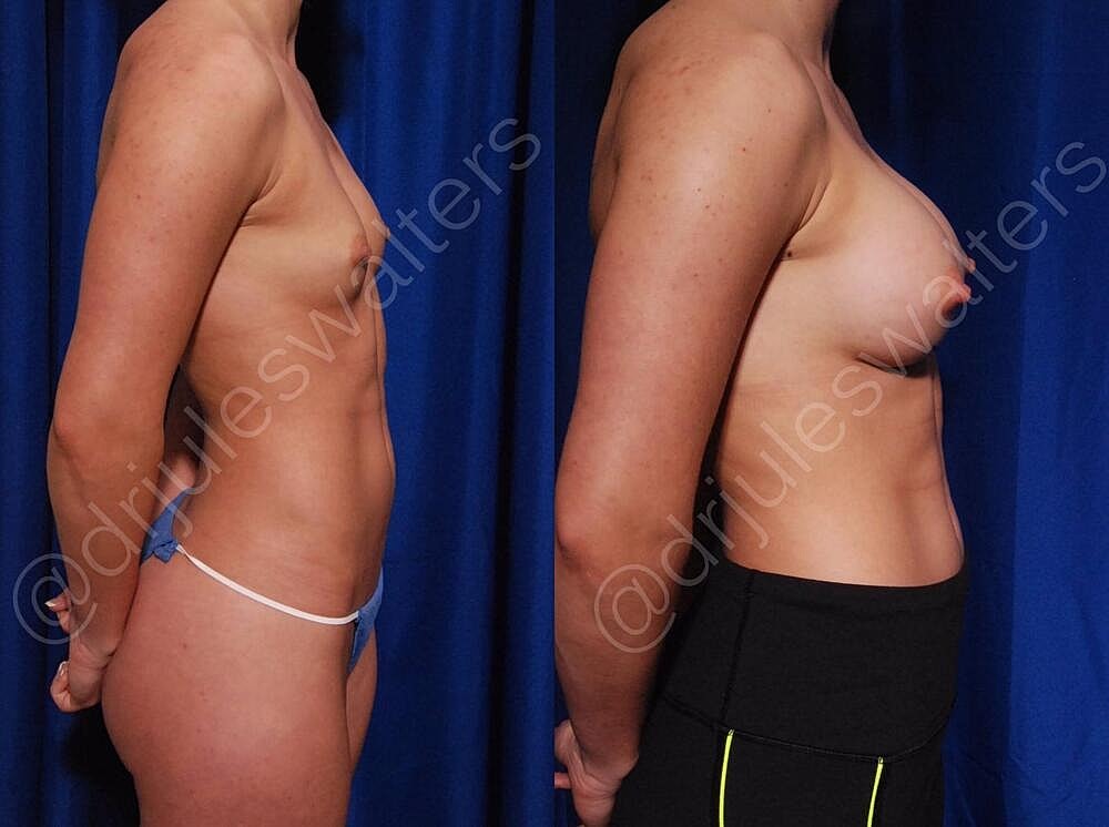 Breast Augmentation Before & After