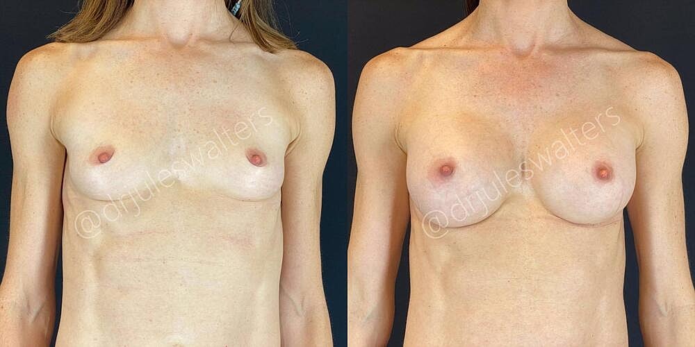 Breast Augmentation Before & After