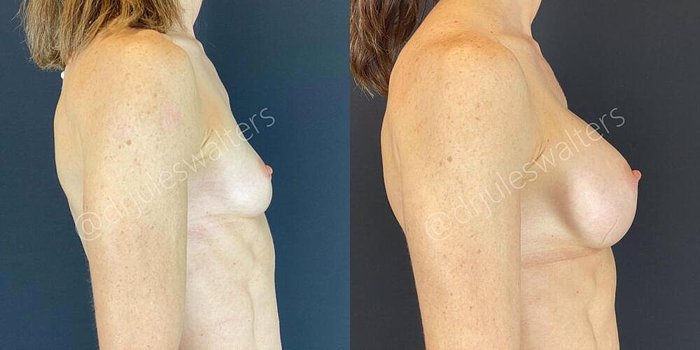 Breast Augmentation Before & After