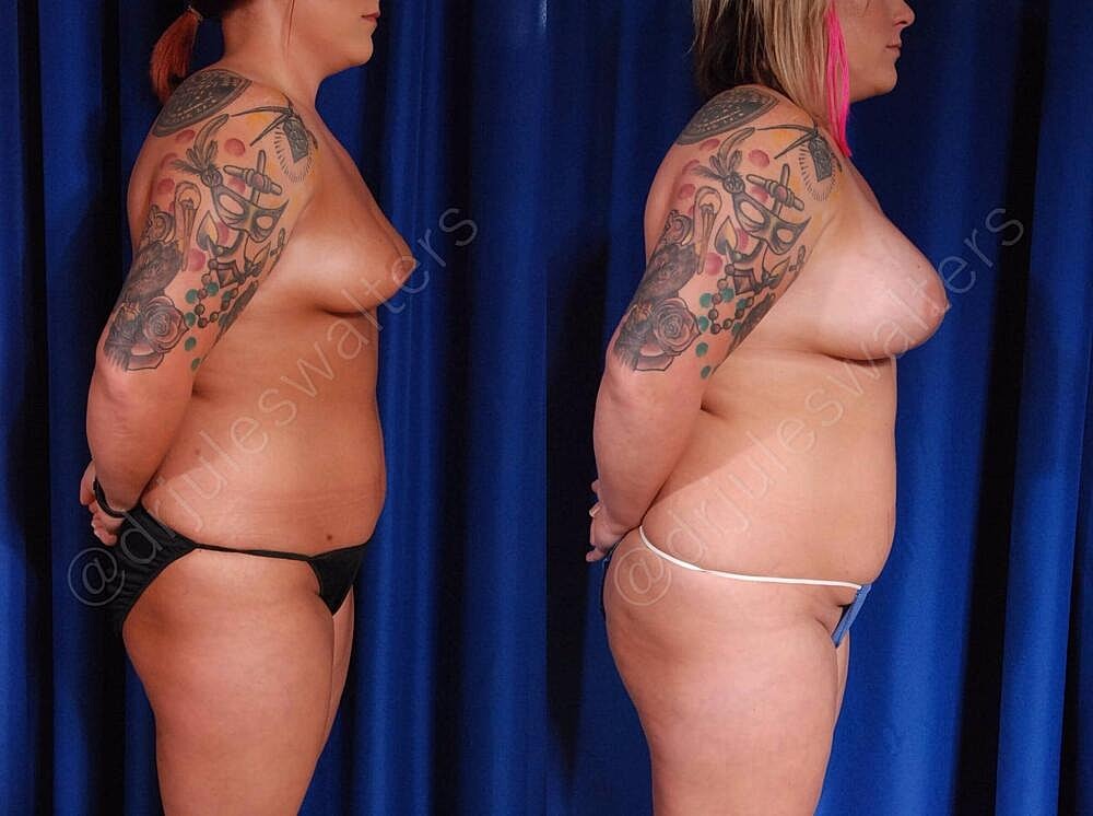 Breast Augmentation Before & After