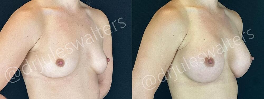 Breast Augmentation Before & After