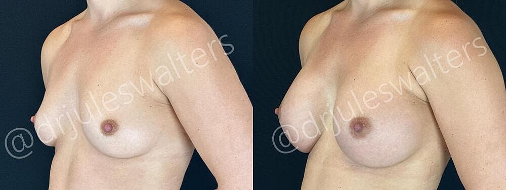 Breast Augmentation Before & After