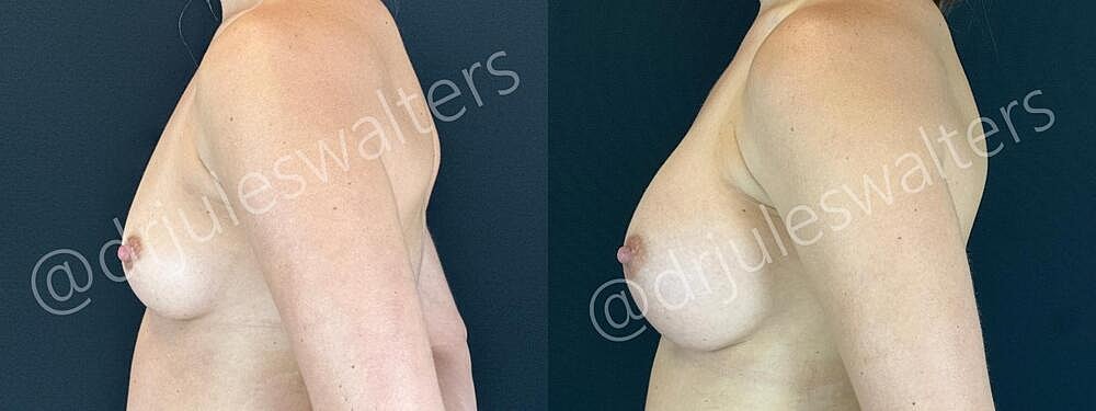 Breast Augmentation Before & After