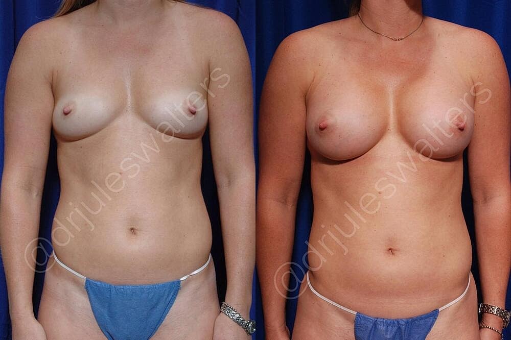 Breast Augmentation Before & After