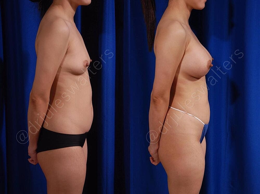 Breast Augmentation Before & After