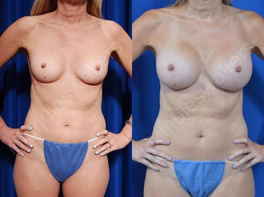Breast Augmentation Before & After