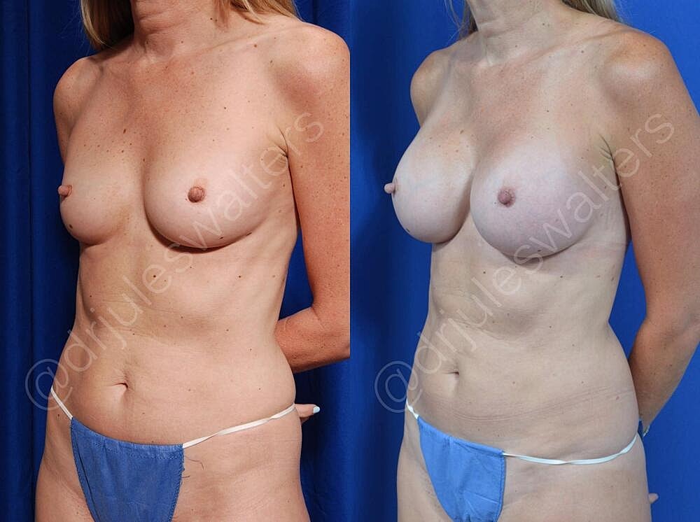 Breast Augmentation Before & After