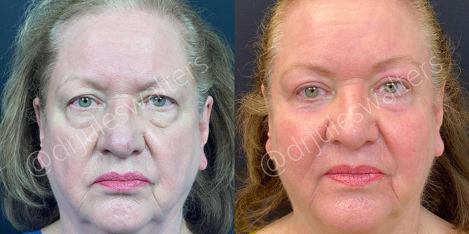 Blepharoplasty Before & After