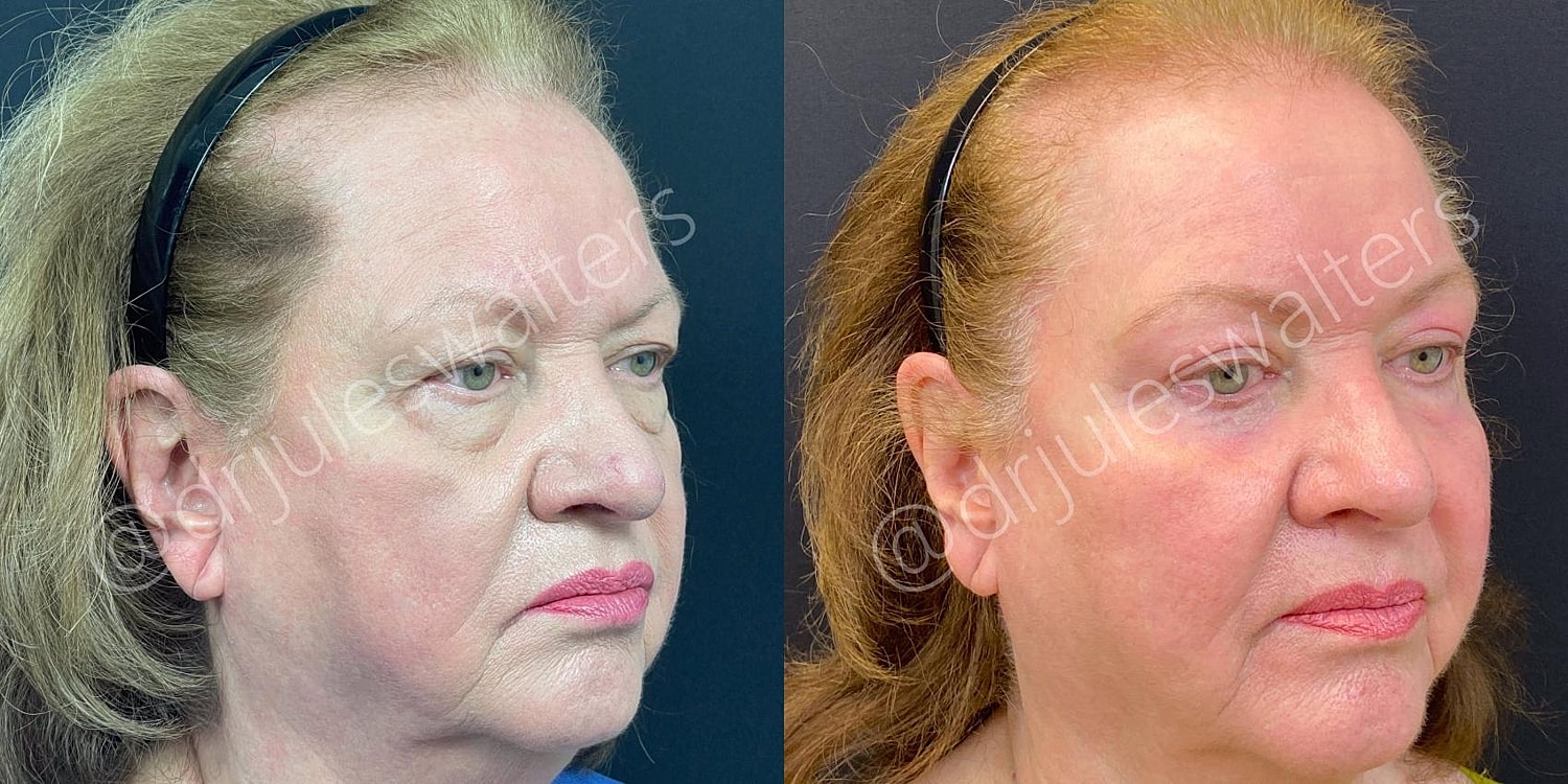Blepharoplasty Before & After