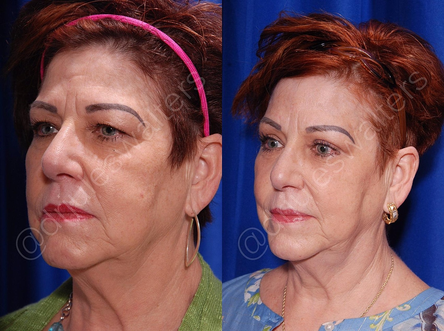 Blepharoplasty Before & After