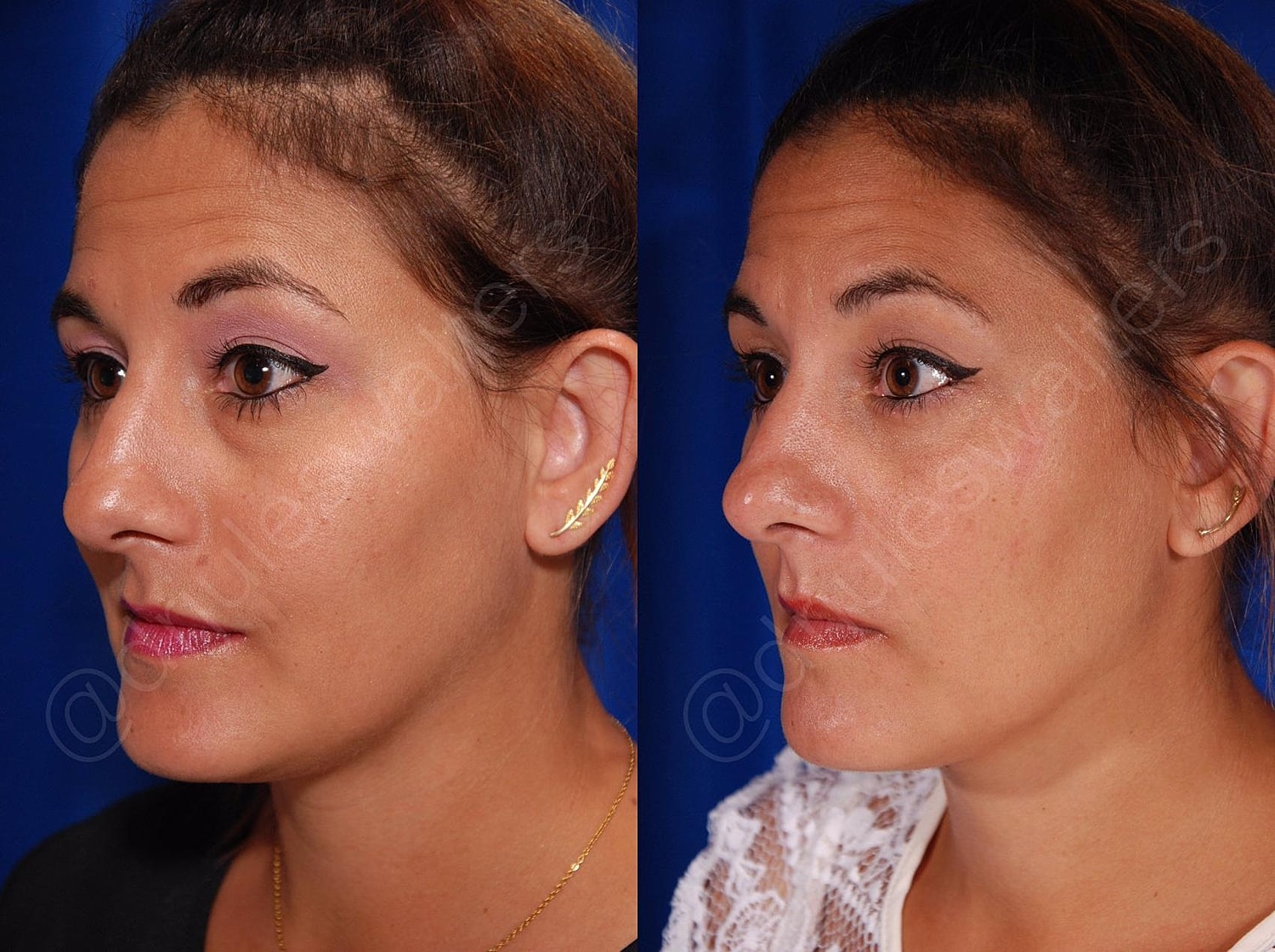 Blepharoplasty Before & After