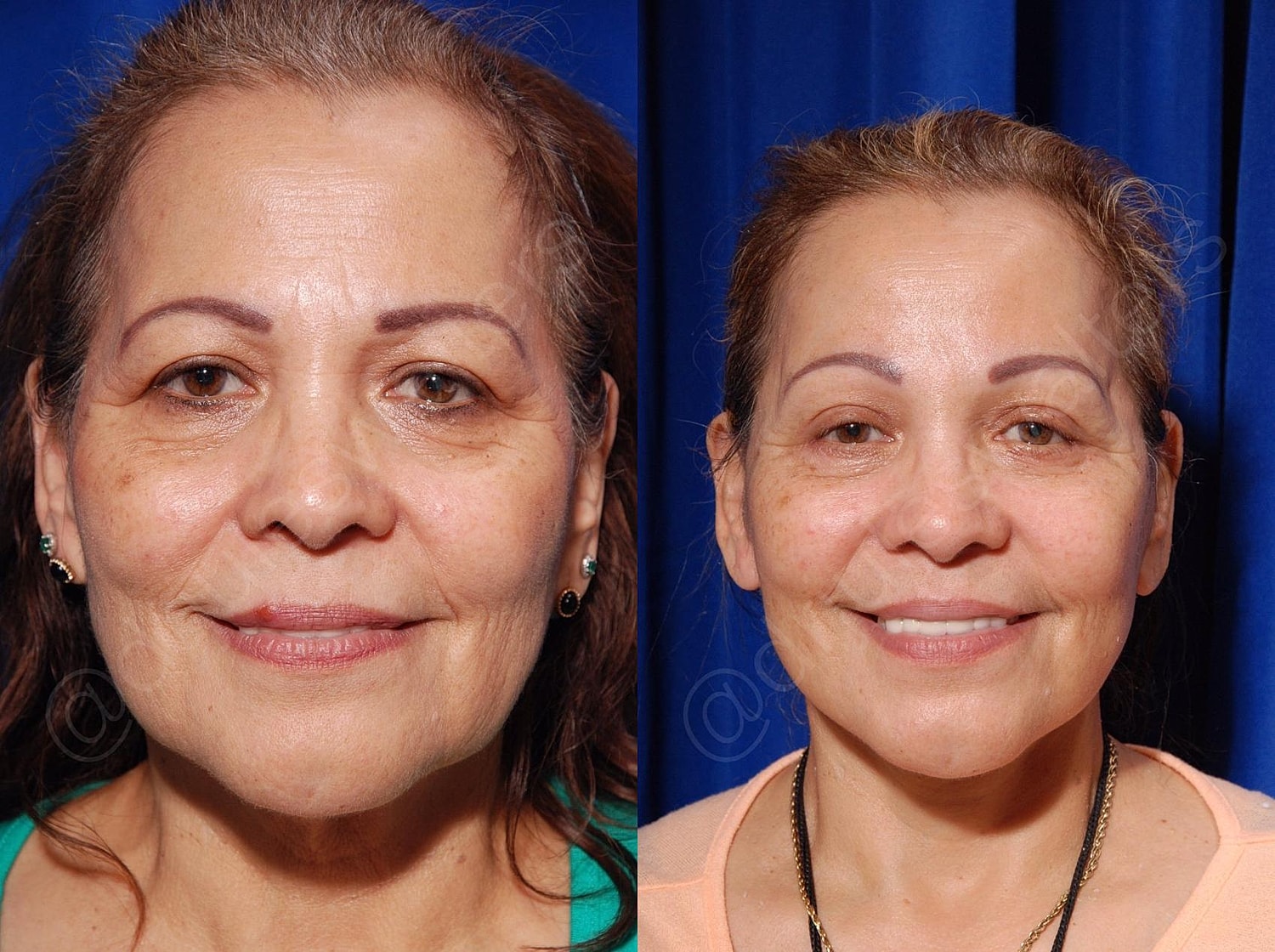 Blepharoplasty Before & After