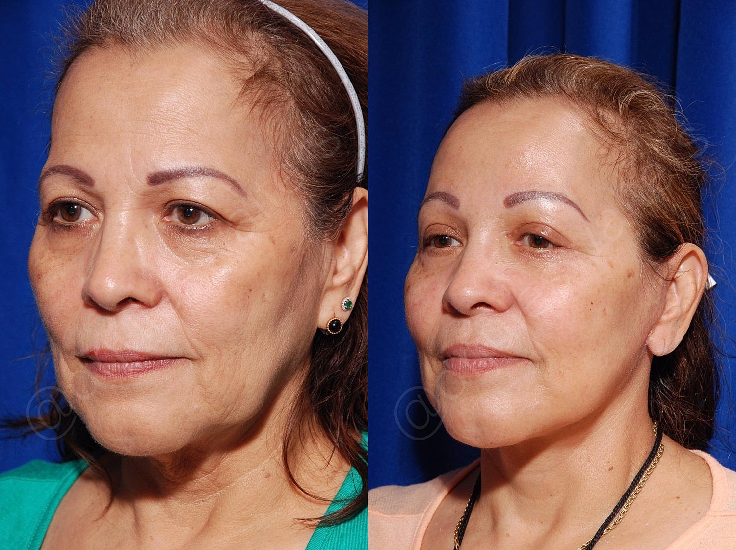 Blepharoplasty Before & After