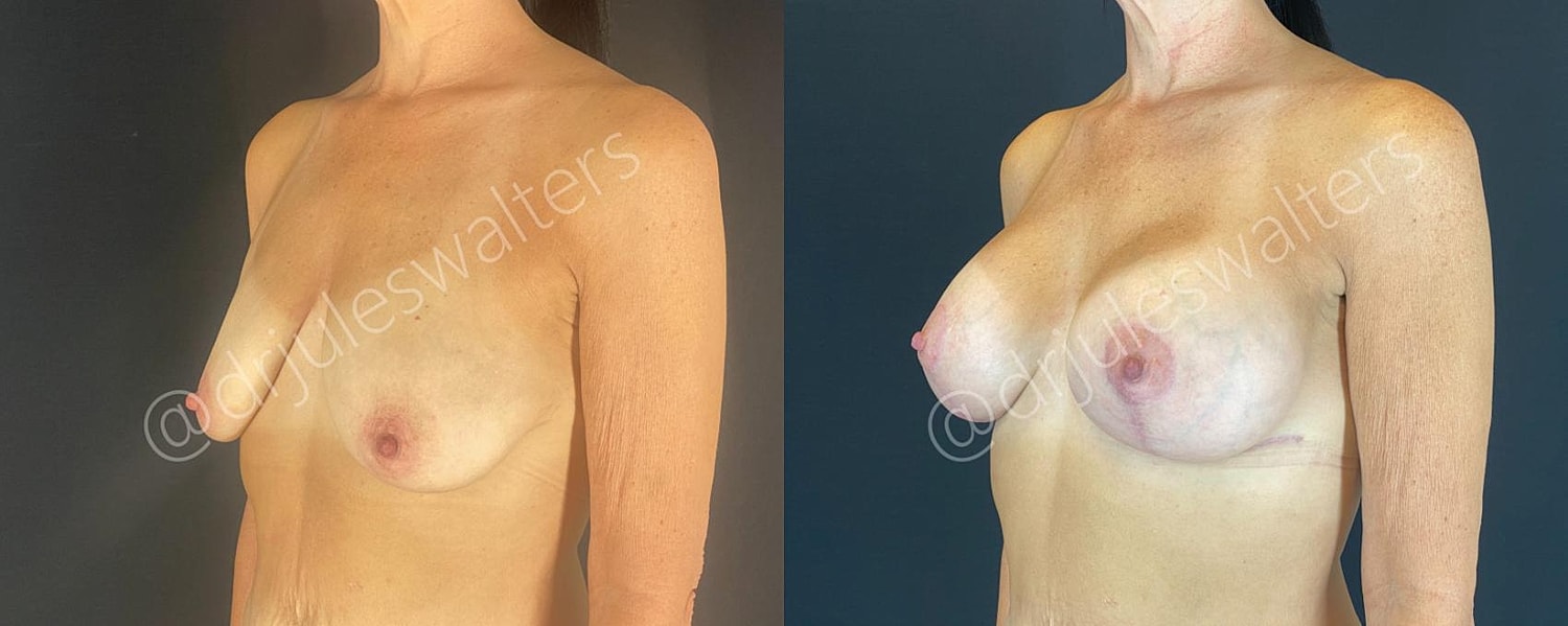 Breast Augmentation Lift Before & After