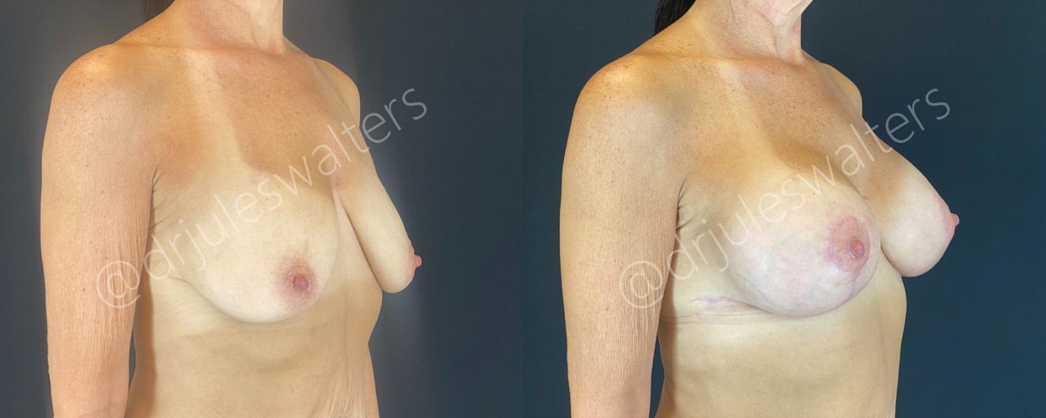 Breast Augmentation Lift Before & After