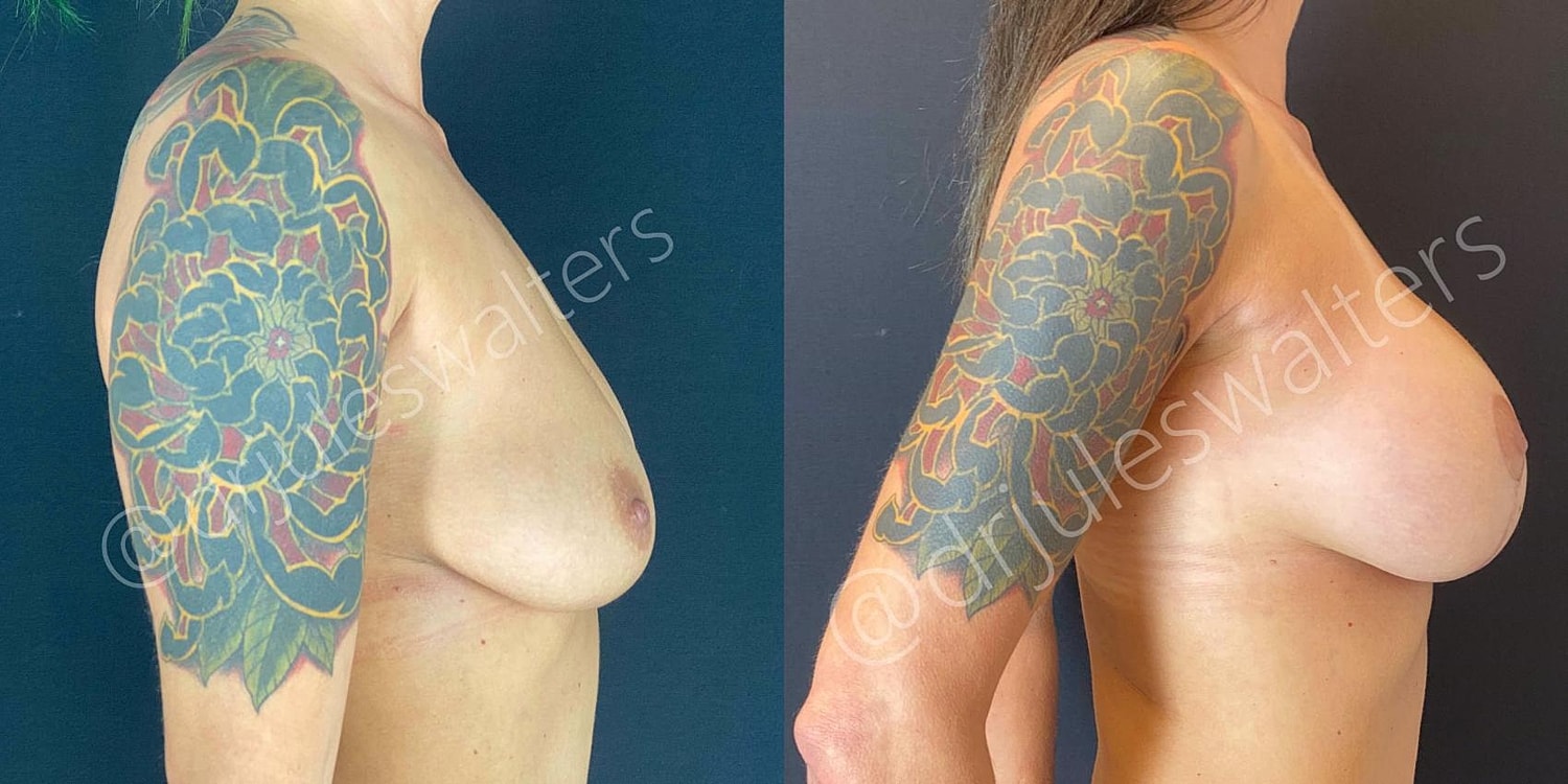 Breast Augmentation Lift Before & After