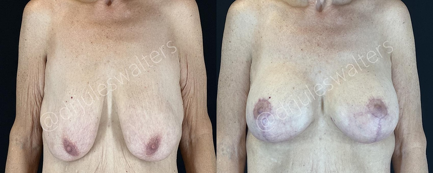 Breast Augmentation Lift Before & After