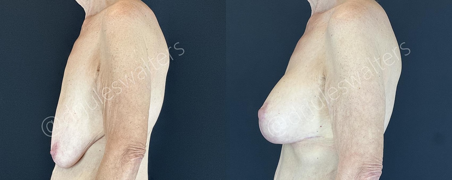 Breast Augmentation Lift Before & After