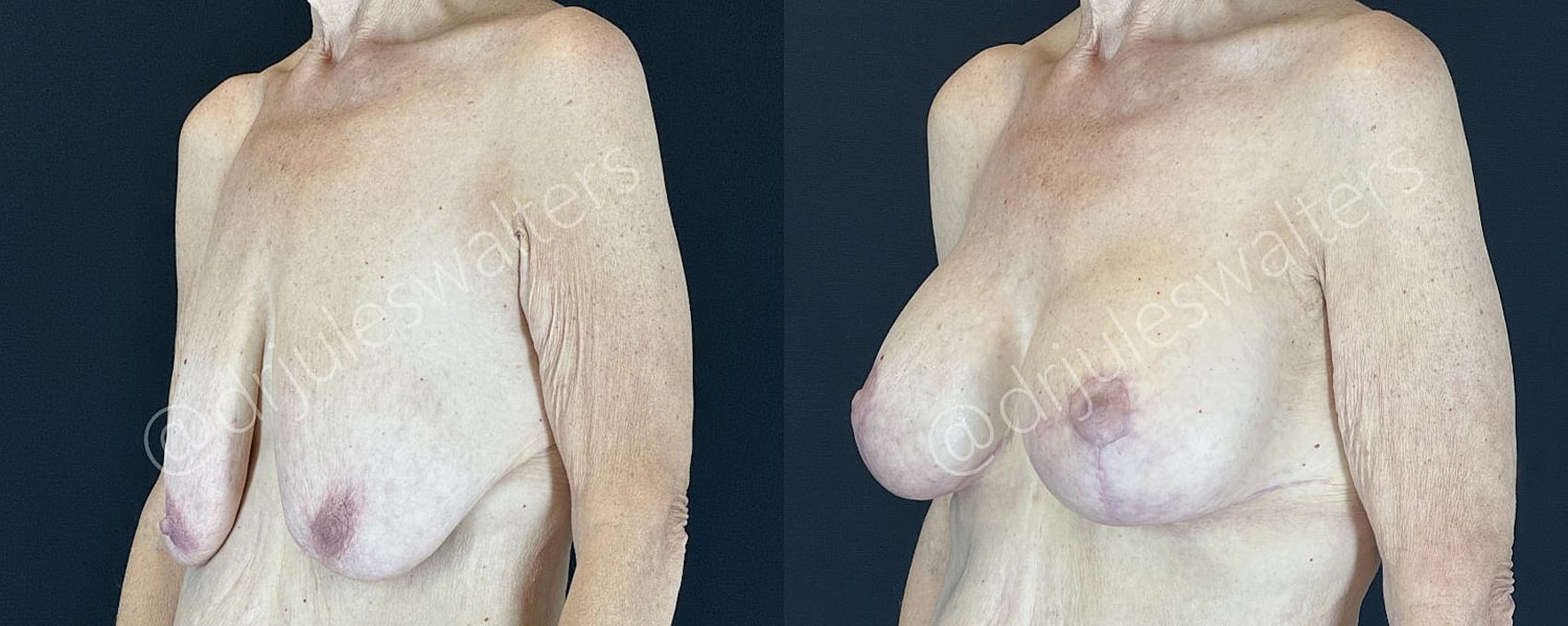Breast Augmentation Lift Before & After