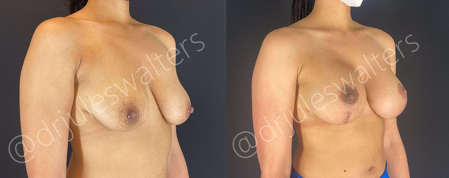 Breast Augmentation Lift Before & After