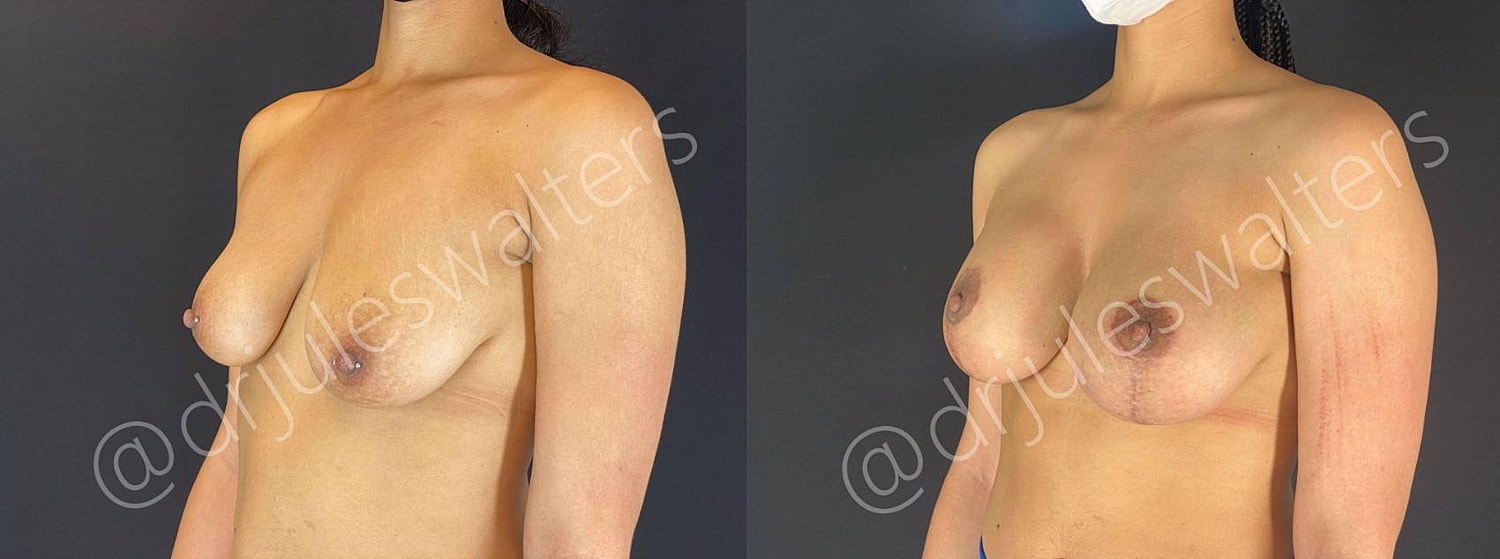 Breast Augmentation Lift Before & After