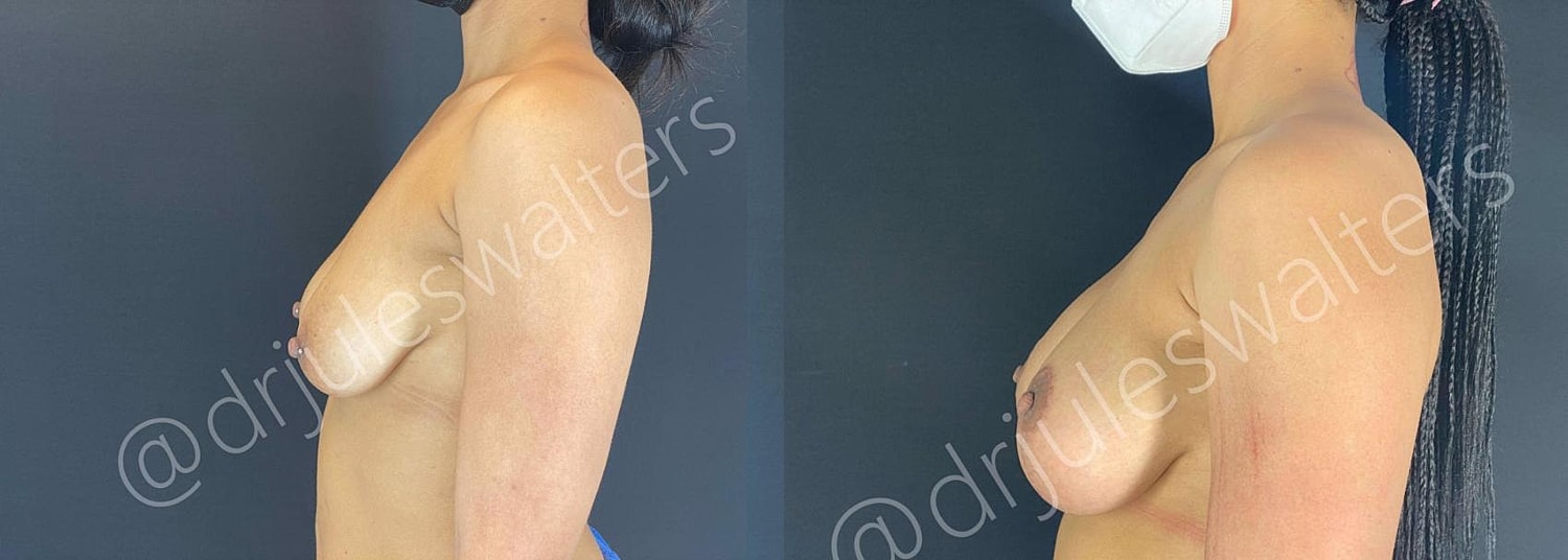 Breast Augmentation Lift Before & After