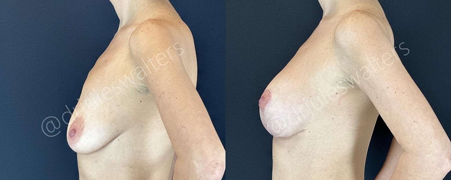 Breast Augmentation Lift Before & After