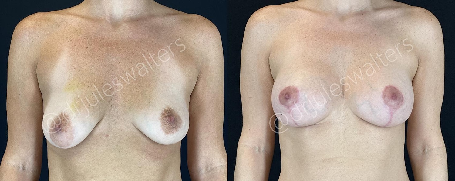 Breast Augmentation Lift Before & After