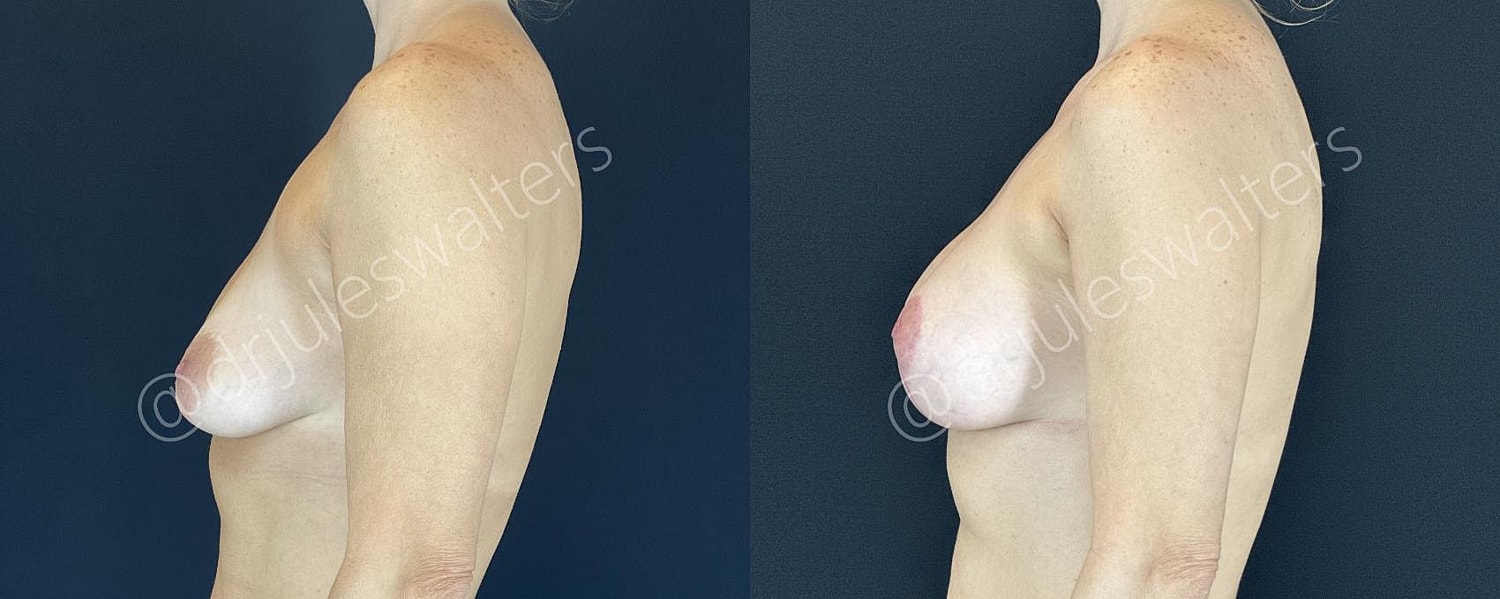 Breast Augmentation Lift Before & After