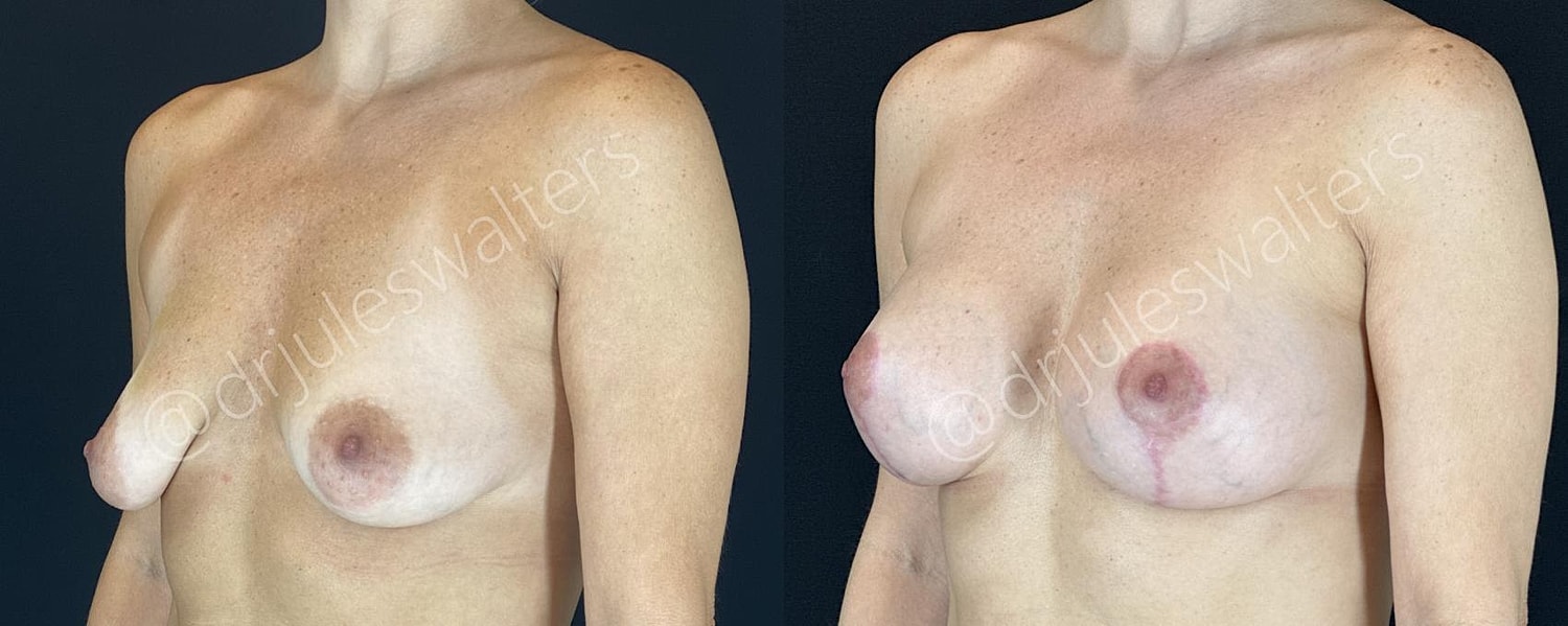 Breast Augmentation Lift Before & After