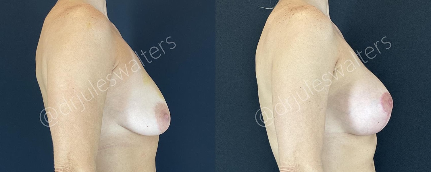 Breast Augmentation Lift Before & After
