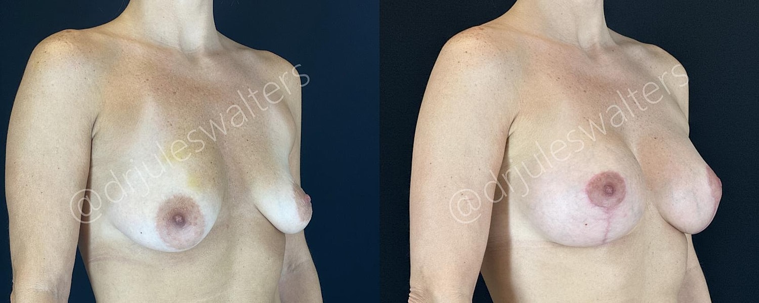 Breast Augmentation Lift Before & After