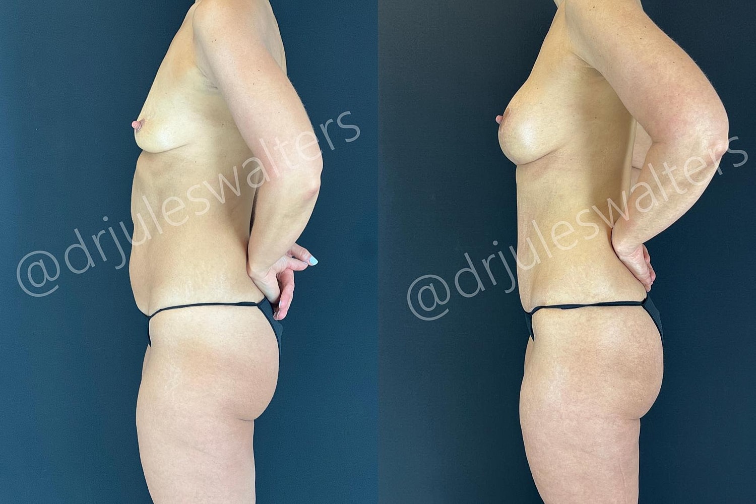 Breast Augmentation Lift Before & After