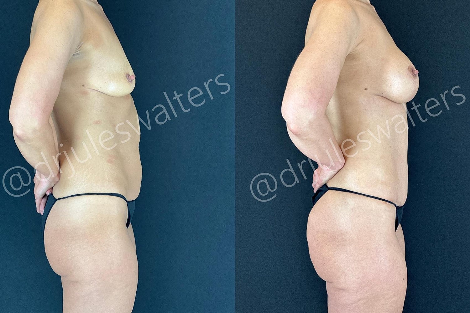 Breast Augmentation Lift Before & After