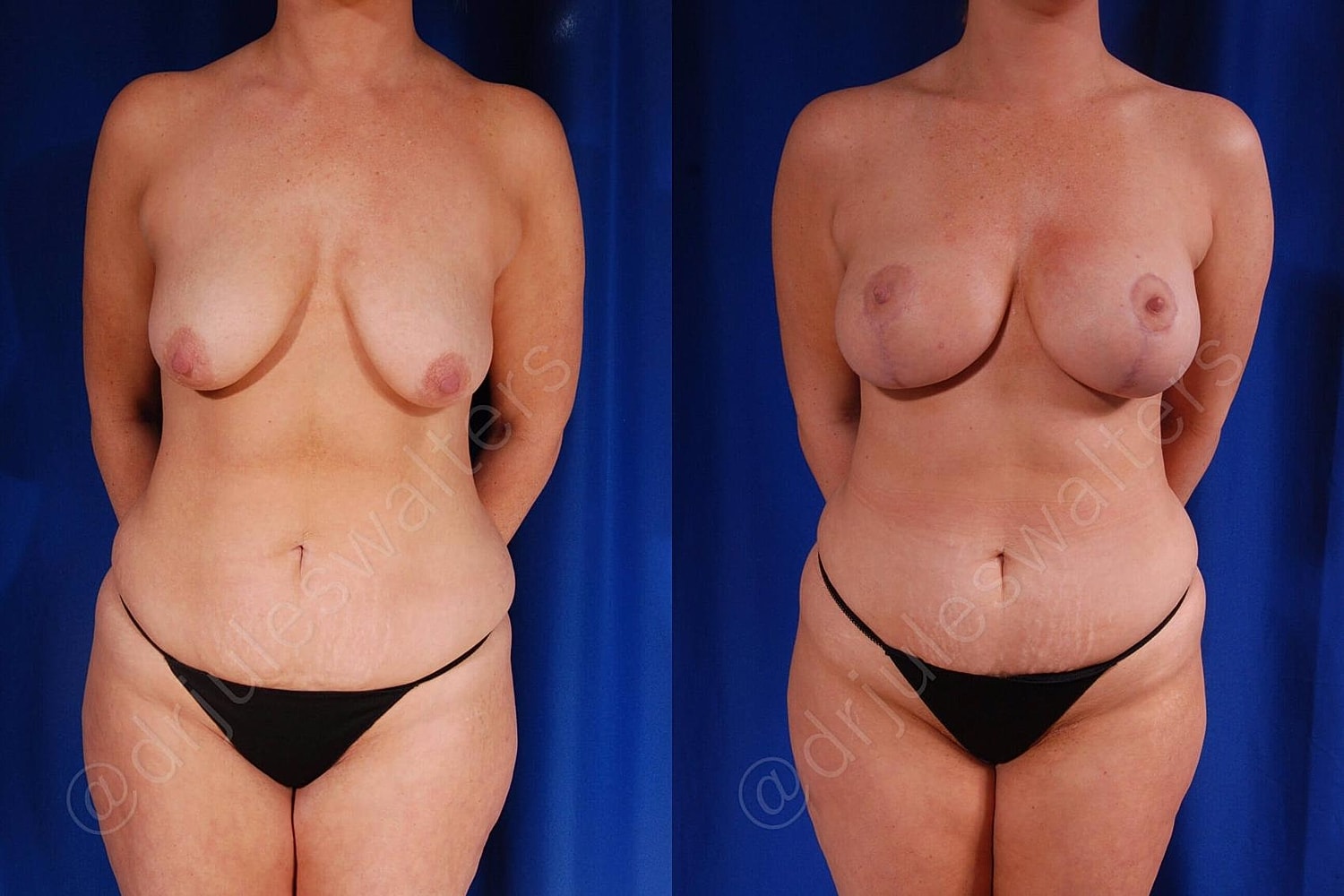 Breast Augmentation Lift Before & After