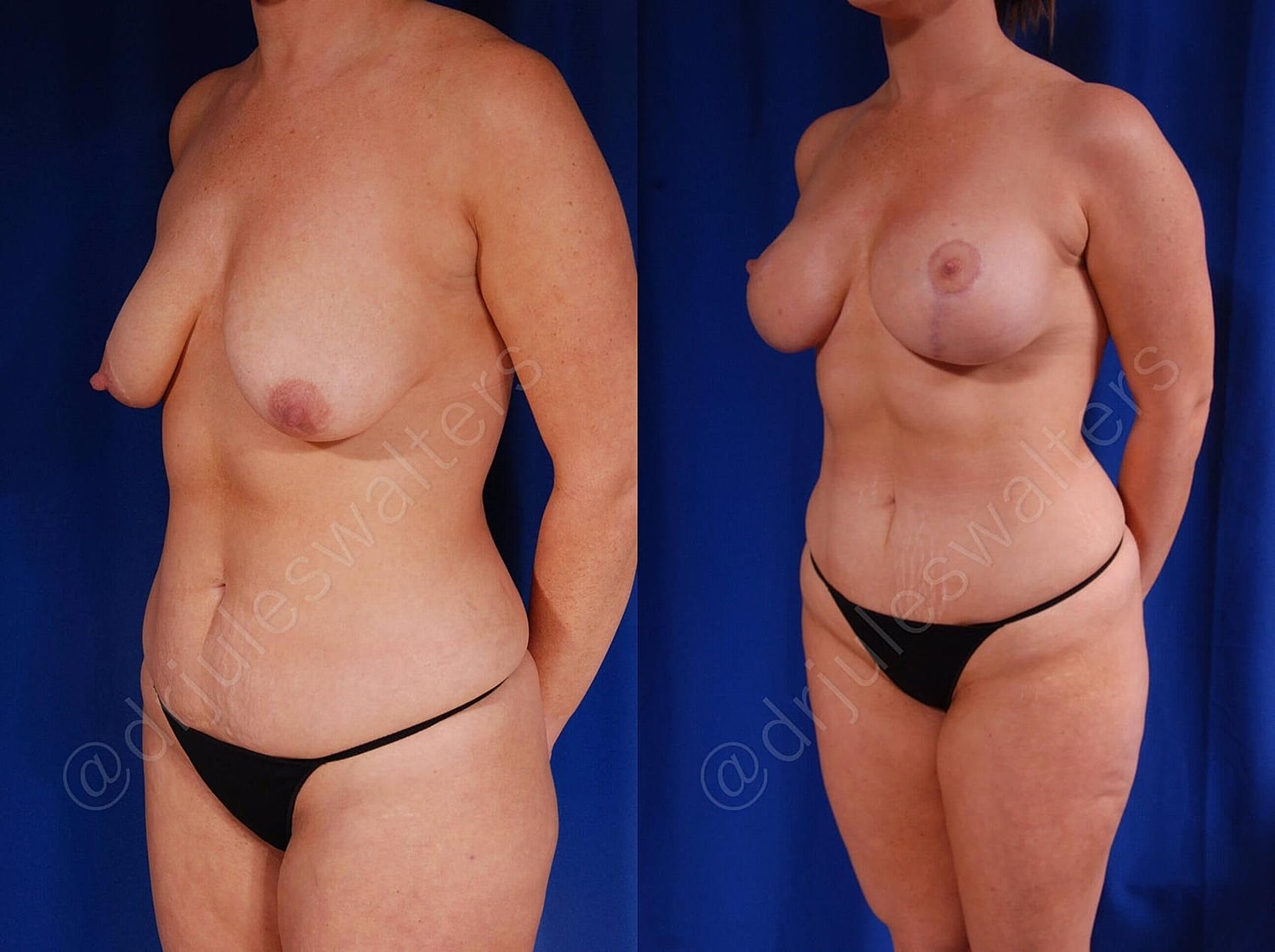 Breast Augmentation Lift Before & After