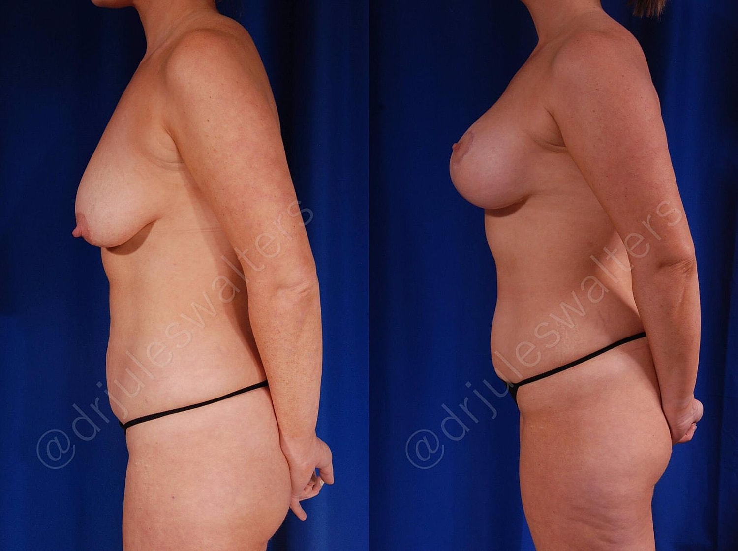 Breast Augmentation Lift Before & After