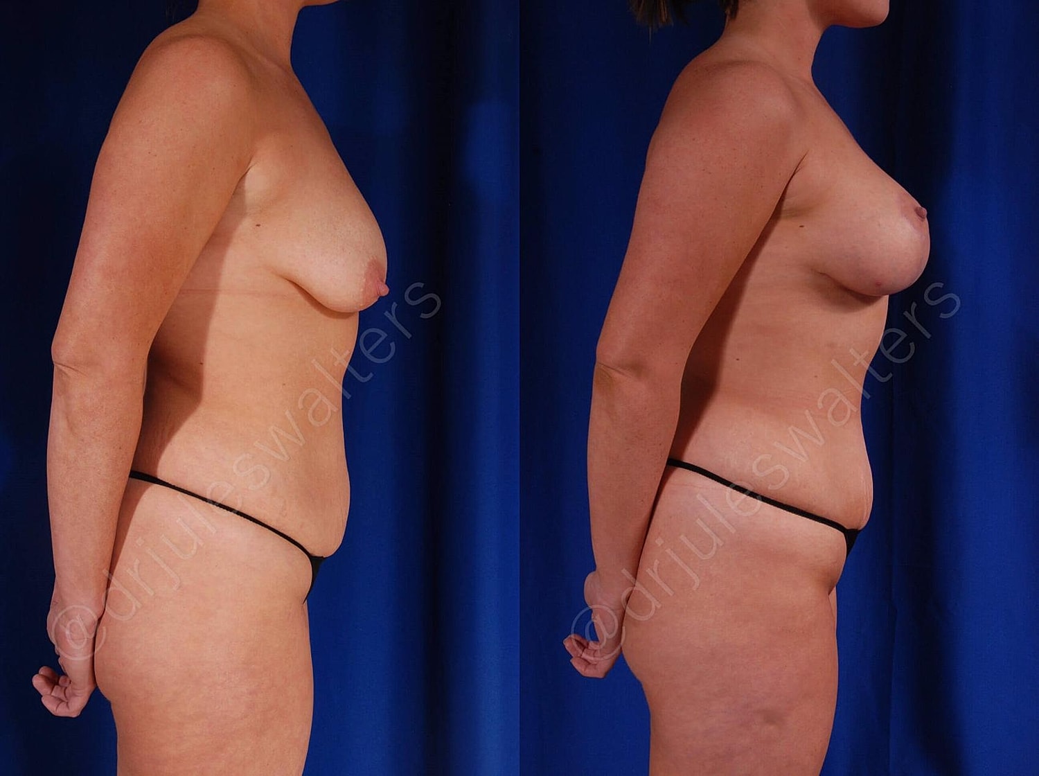 Breast Augmentation Lift Before & After