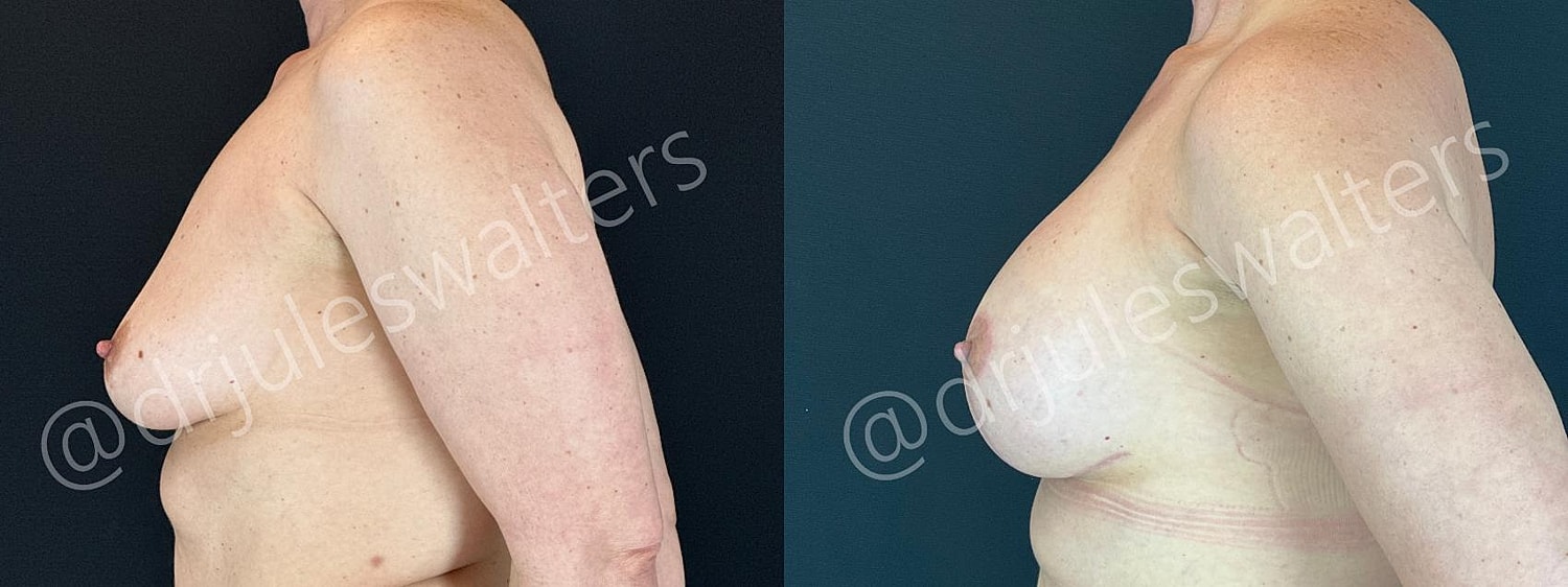 Breast Augmentation Lift Before & After