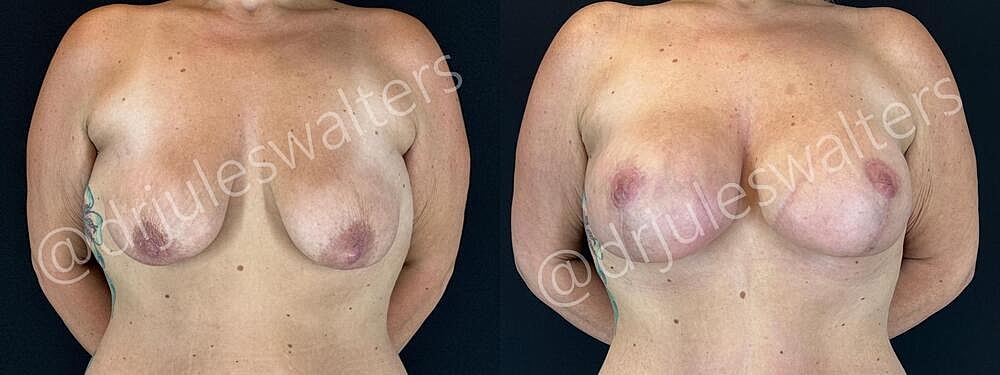 Breast Augmentation Lift Before & After